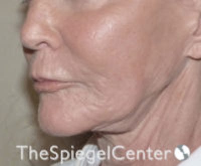 Neck Botox Before & After Gallery - Patient 595932 - Image 1