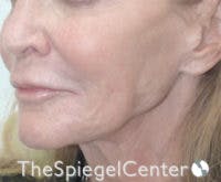 Neck Botox Before & After Gallery - Patient 595932 - Image 2