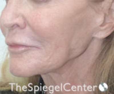 Neck Botox Before & After Gallery - Patient 595932 - Image 2