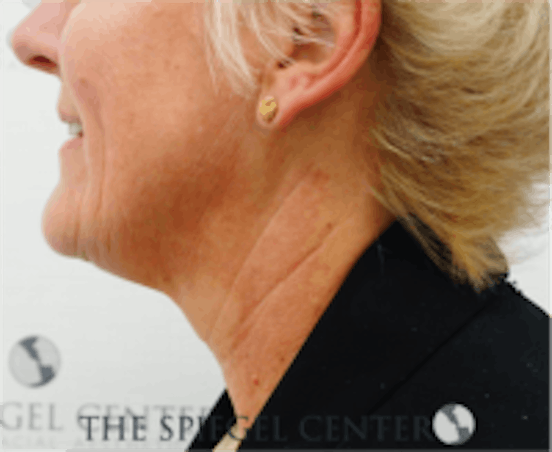 Neck Botox Before & After Gallery - Patient 184571 - Image 1
