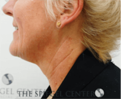 Neck Botox Before & After Gallery - Patient 184571 - Image 1