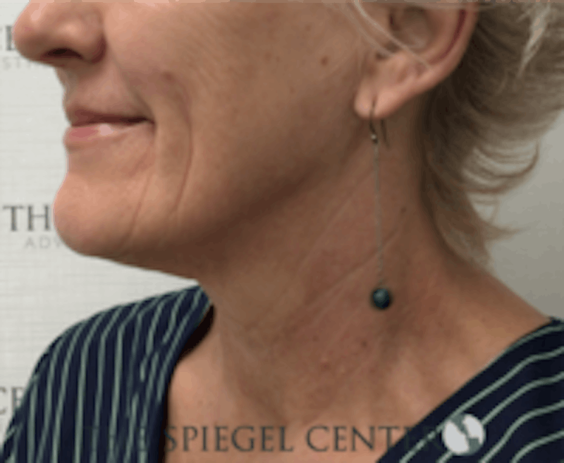 Neck Botox Before & After Gallery - Patient 184571 - Image 2