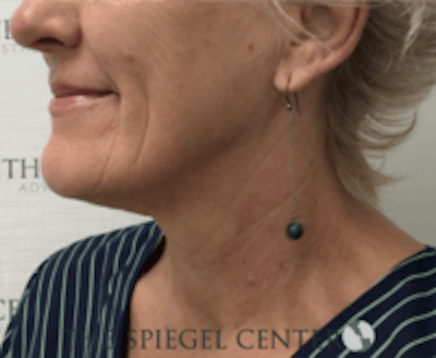 Neck Botox Before & After Gallery - Patient 184571 - Image 2