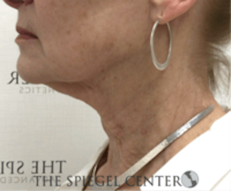 Neck Botox Before & After Gallery - Patient 224354 - Image 1