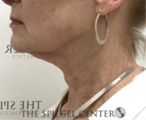 Neck Botox Before & After Gallery - Patient 224354 - Image 1