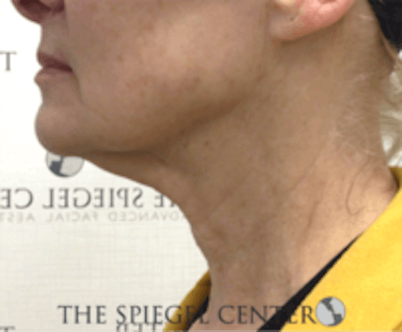 Neck Botox Before & After Gallery - Patient 224354 - Image 2