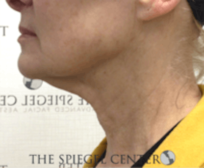 Neck Botox Before & After Gallery - Patient 224354 - Image 2