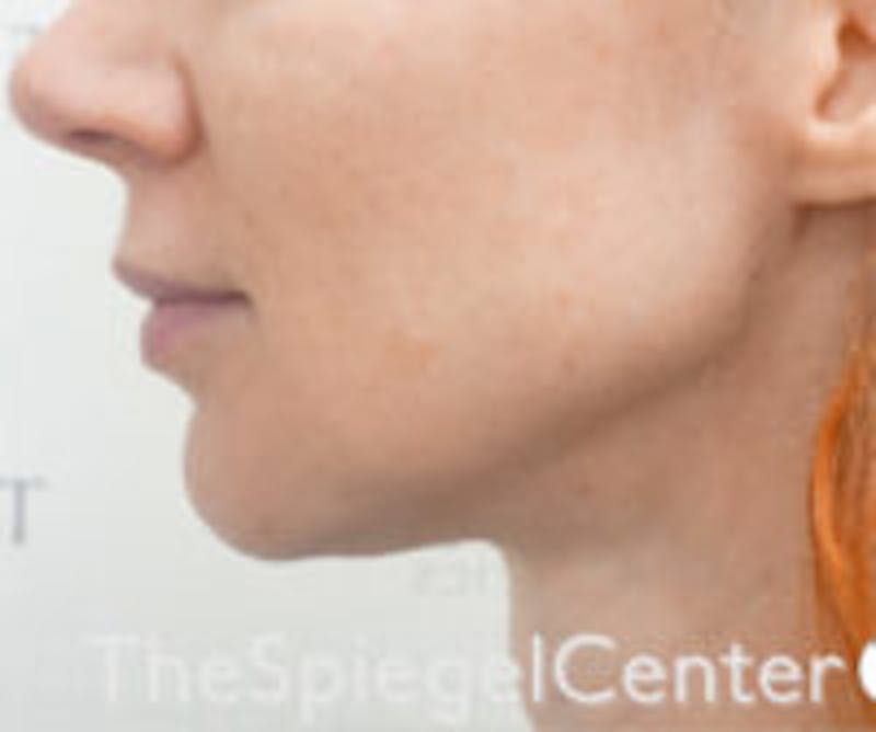 Neck Botox Before & After Gallery - Patient 199777 - Image 2