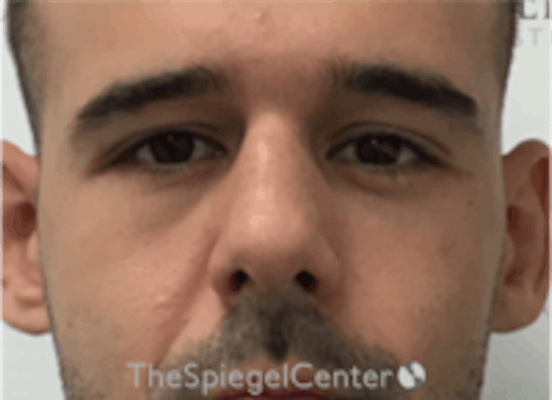 Non-Surgical Rhinoplasty / Nose Filler Before & After Gallery - Patient 211489 - Image 1