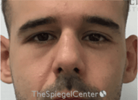 Non-Surgical Rhinoplasty / Nose Filler Before & After Gallery - Patient 211489 - Image 1
