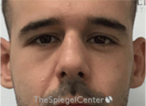 Non-Surgical Rhinoplasty / Nose Filler Before & After Gallery - Patient 211489 - Image 1