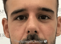 Non-Surgical Rhinoplasty / Nose Filler Before & After Gallery - Patient 211489 - Image 2