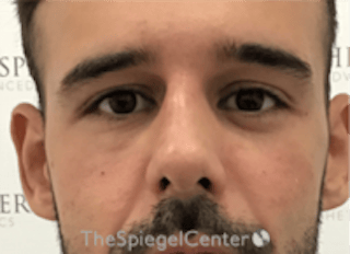 Non-Surgical Rhinoplasty / Nose Filler Before & After Gallery - Patient 211489 - Image 2