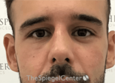 Non-Surgical Rhinoplasty / Nose Filler Before & After Gallery - Patient 211489 - Image 2