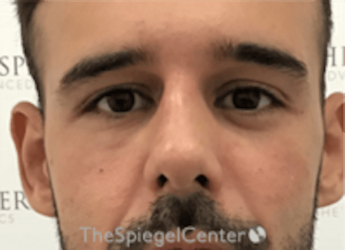 Non-Surgical Rhinoplasty / Nose Filler Before & After Gallery - Patient 211489 - Image 2