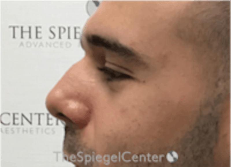 Non-Surgical Rhinoplasty / Nose Filler Before & After Gallery - Patient 211489 - Image 3