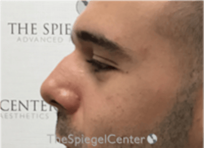 Non-Surgical Rhinoplasty / Nose Filler Before & After Gallery - Patient 211489 - Image 3