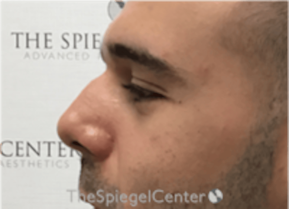 Non-Surgical Rhinoplasty