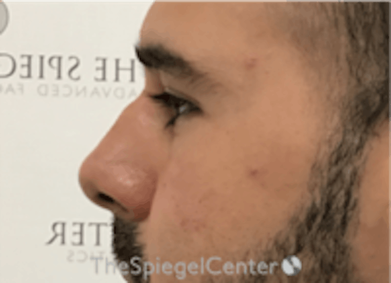 Non-Surgical Rhinoplasty / Nose Filler Before & After Gallery - Patient 211489 - Image 4
