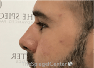 Non-Surgical Rhinoplasty / Nose Filler Before & After Gallery - Patient 211489 - Image 4