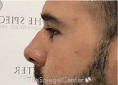 Non-Surgical Rhinoplasty / Nose Filler Before & After Gallery - Patient 211489 - Image 4