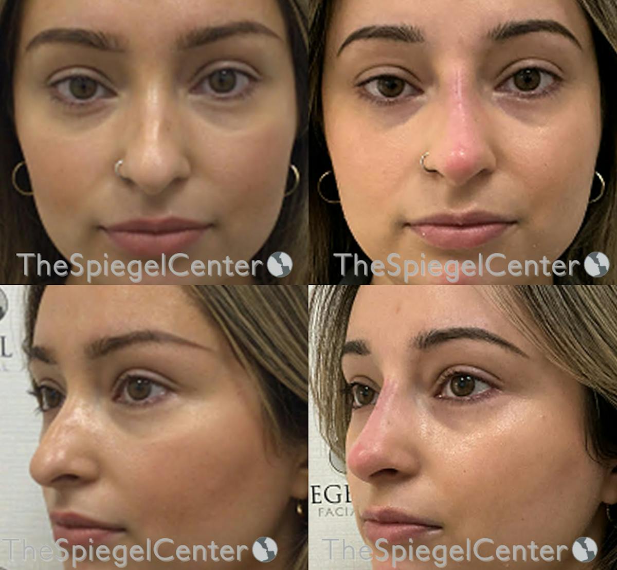 Non-Surgical Rhinoplasty / Nose Filler Before & After Gallery - Patient 302567 - Image 1