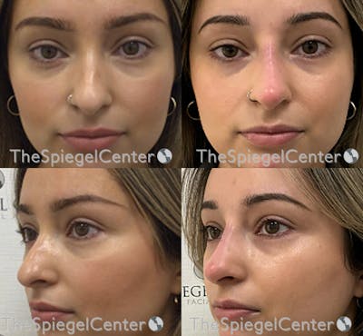 Non-Surgical Rhinoplasty / Nose Filler Before & After Gallery - Patient 302567 - Image 1