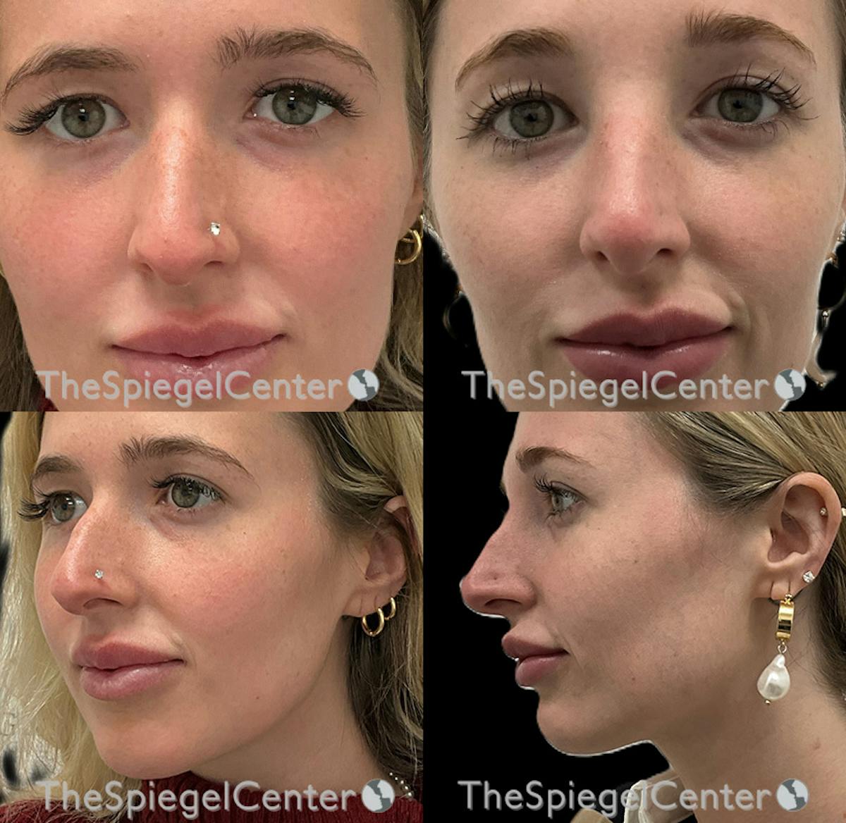 Non-Surgical Rhinoplasty / Nose Filler Before & After Gallery - Patient 513527 - Image 1