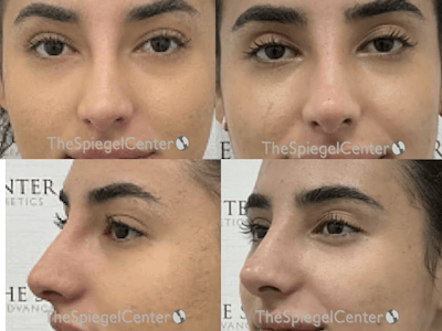 Non-Surgical Rhinoplasty / Nose Filler Before & After Gallery - Patient 870510 - Image 1