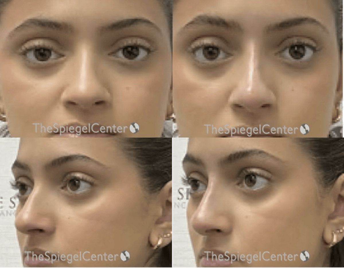 Non-Surgical Rhinoplasty / Nose Filler Before & After Gallery - Patient 615657 - Image 1