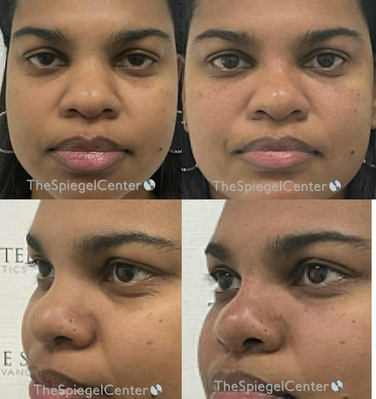 Non-Surgical Rhinoplasty / Nose Filler Before & After Gallery - Patient 225679 - Image 1