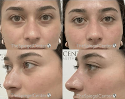 Non-Surgical Rhinoplasty / Nose Filler Before & After Gallery - Patient 418367 - Image 1
