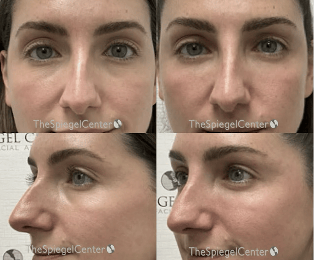 Non-Surgical Rhinoplasty / Nose Filler Before & After Gallery - Patient 274330 - Image 1