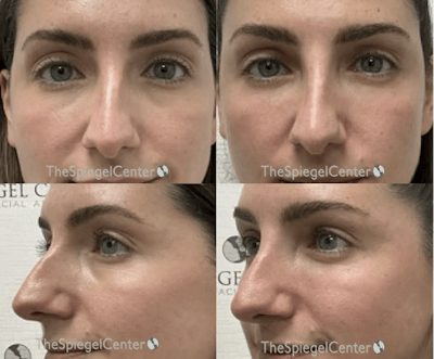 Non-Surgical Rhinoplasty / Nose Filler Before & After Gallery - Patient 274330 - Image 1