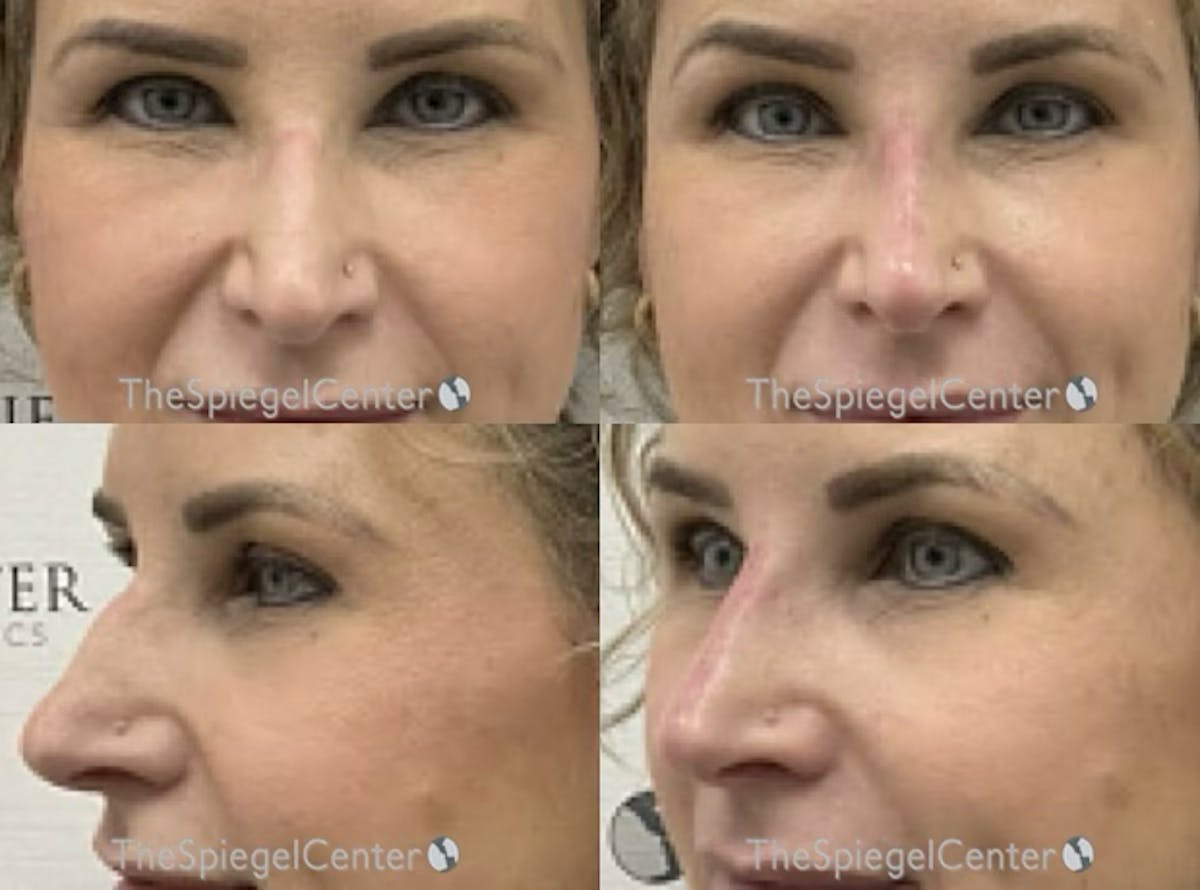 Non-Surgical Rhinoplasty / Nose Filler Before & After Gallery - Patient 521205 - Image 1