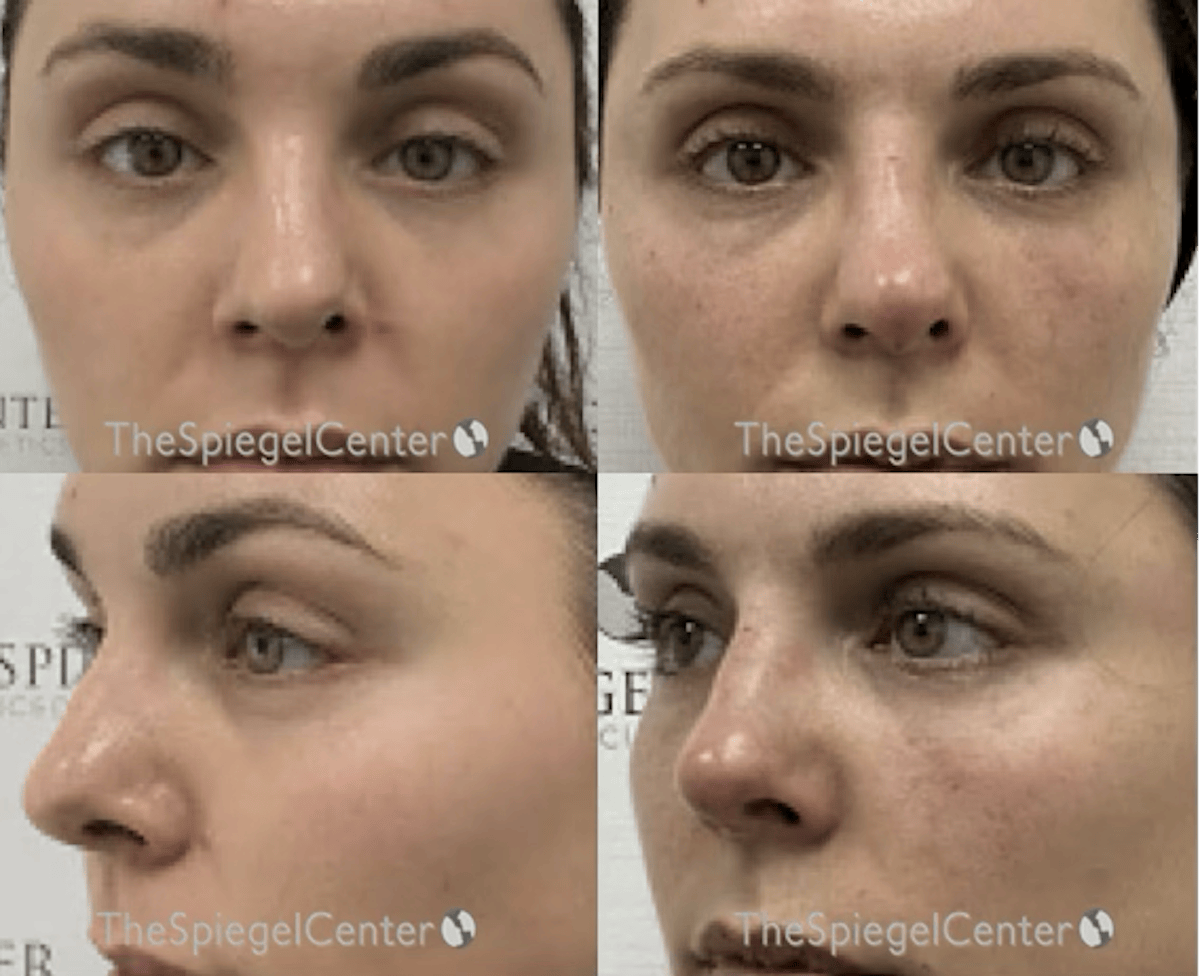 Non-Surgical Rhinoplasty / Nose Filler Before & After Gallery - Patient 109595 - Image 1