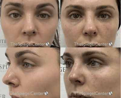 Non-Surgical Rhinoplasty / Nose Filler Before & After Gallery - Patient 109595 - Image 1