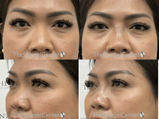 Non-Surgical Rhinoplasty / Nose Filler Before & After Gallery - Patient 332969 - Image 1