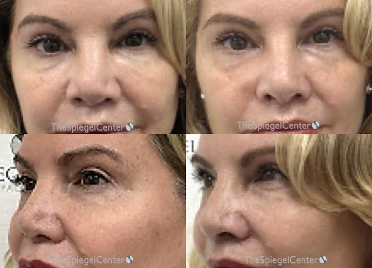 Non-Surgical Rhinoplasty / Nose Filler Before & After Gallery - Patient 332794 - Image 1