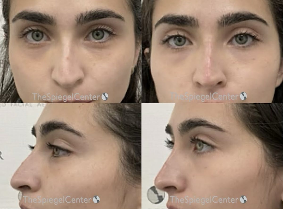 Non-Surgical Rhinoplasty / Nose Filler Before & After Gallery - Patient 389902 - Image 1