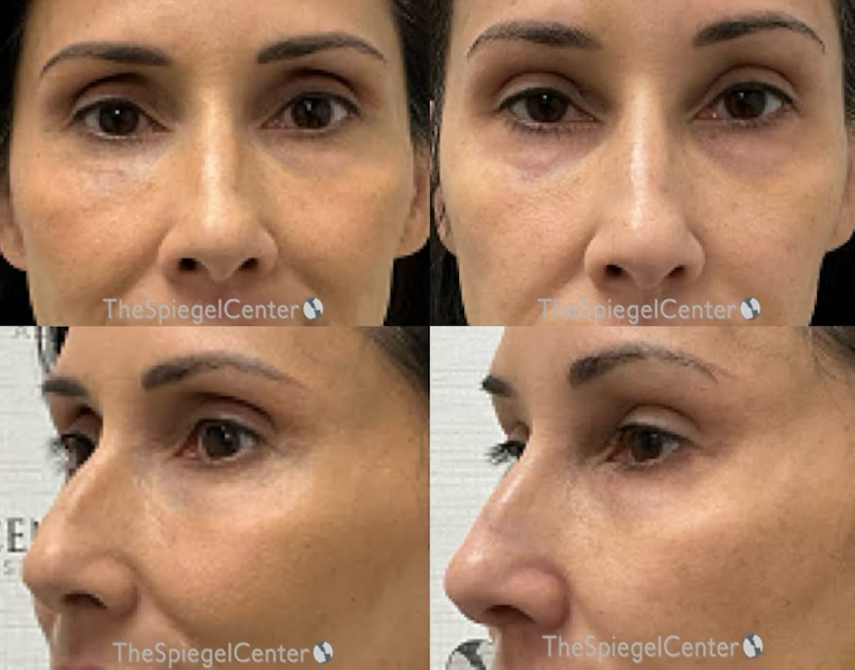 Non-Surgical Rhinoplasty / Nose Filler Before & After Gallery - Patient 420320 - Image 1