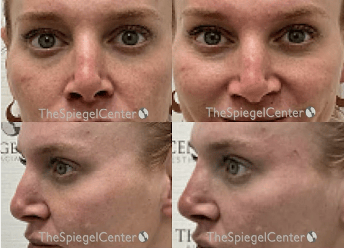Non-Surgical Rhinoplasty / Nose Filler Before & After Gallery - Patient 267754 - Image 1