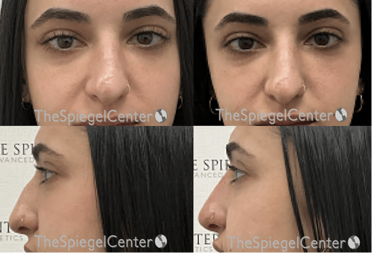 Non-Surgical Rhinoplasty / Nose Filler Before & After Gallery - Patient 407968 - Image 1