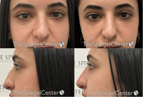 Non-Surgical Rhinoplasty / Nose Filler Before & After Gallery - Patient 407968 - Image 1