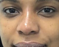 Non-Surgical Rhinoplasty / Nose Filler Before & After Gallery - Patient 345942 - Image 2