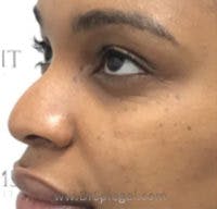 Non-Surgical Rhinoplasty / Nose Filler Before & After Gallery - Patient 345942 - Image 3