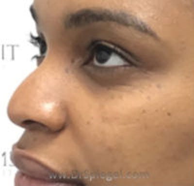Non-Surgical Rhinoplasty / Nose Filler Before & After Gallery - Patient 345942 - Image 3
