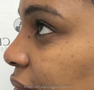 Non-Surgical Rhinoplasty / Nose Filler Before & After Gallery - Patient 345942 - Image 4