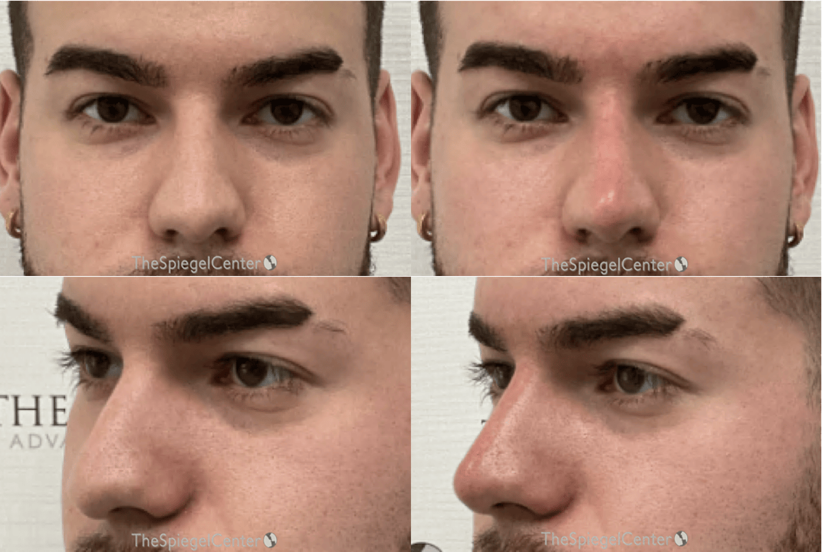 Non-Surgical Rhinoplasty / Nose Filler Before & After Gallery - Patient 237418 - Image 1
