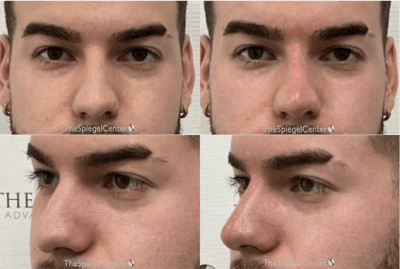 Non-Surgical Rhinoplasty / Nose Filler Before & After Gallery - Patient 237418 - Image 1